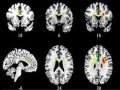 Ученые впервые определили воздействие любви на мозг | техномания