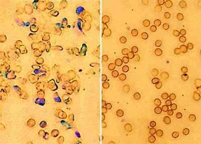 Разработан безопасный метод исправления мутаций кроветворных клеток