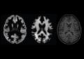 Нейросеть научилась определять возраст мозга по МРТ | техномания
