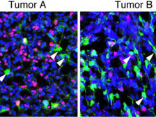 Учёные нашли стволовые клетки раковых опухолей